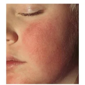 wykwity skórne na twarzy u dziecka