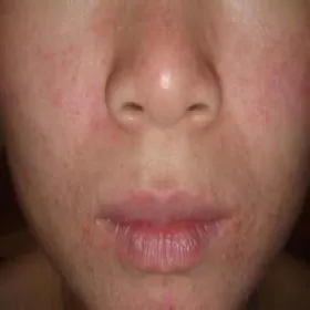 wyprysk łojotokowy u dziecka