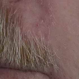 wyprysk łojotokowy u mężczyzny na twarzy