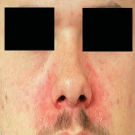 wyprysk łojotokowy zdjęcie