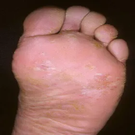 wyprysk dyshydrotyczny na kobalt