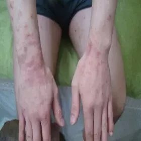 wyprysk alergiczny na dłoniach