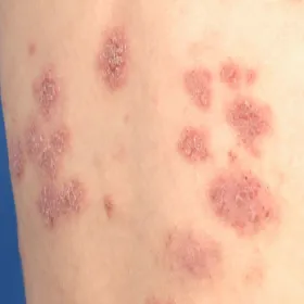 wyprysk pieniążkowaty objawy 