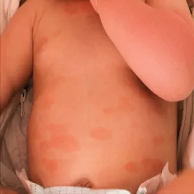 wyprysk pieniążkowaty u dzieci