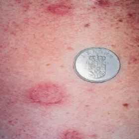 wyprysk pieniążkowaty zdjęcie