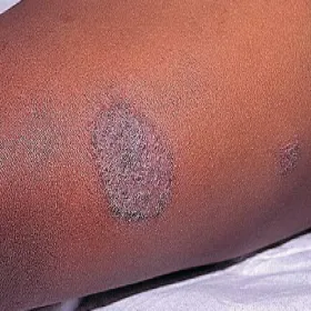 wyprysk pieniążkowy