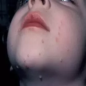 wysypka grudki na twarzy u dziecka 