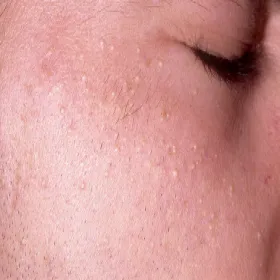 wysypka na twarzy białe krostki wągry