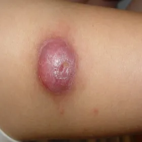 xanthogranuloma juvenile na skórze