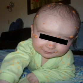 xanthogranuloma juvenile u dzieci