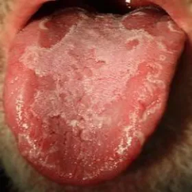 złuszczające zapalenie języka