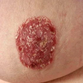 złuszczanie się skóry na brodawce