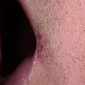 zaczerwienienie w kącikach ust