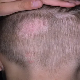 zakażenia grzybicze od kota