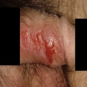 zakażenia wirusowe zapalenie napletka