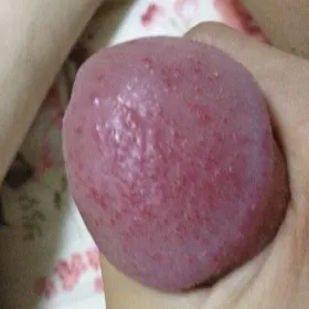 zapalenie żołędzi zdjęcia balanitis