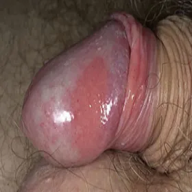 zapalenie żołędzia