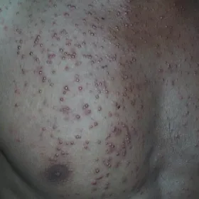 zapalenie mieszków włosowych na klatce piersiowej