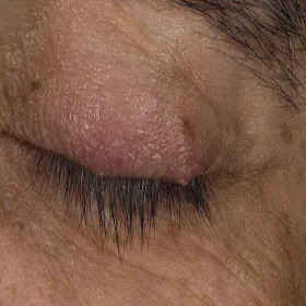 zapalenie mieszków włosowych na powiece