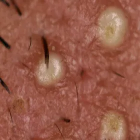 zapalenie mieszków włosowych zmiany ropne