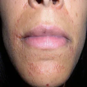 zapalenie okołoustne jak wygląda