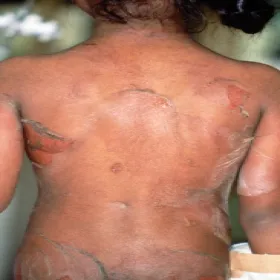 zapalenie pęcherzowe i złuszczające skóry 