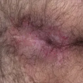 zapalenie skóry między pośladkami odparzenia