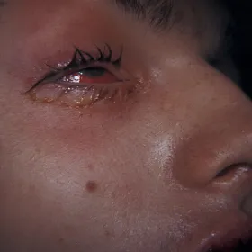 zapalenie spojówek Zespół Stevensa- Johnsona