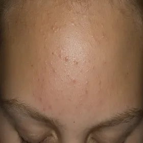 zaskórniki zamknięte kaszka na czole