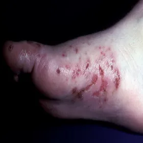 zespół Danbolta-Clossa 