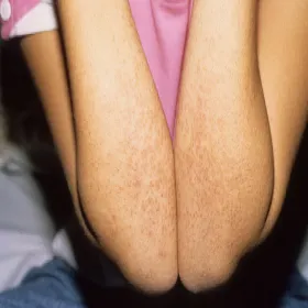 zespół Kawasakiego 