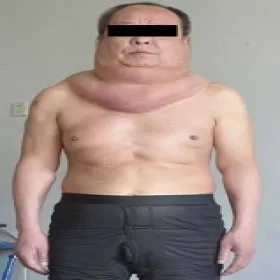 zespół Launois-Bensaude 