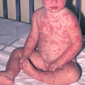 zespół lyella u dzieci