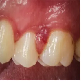 ziarniniak ciążowy