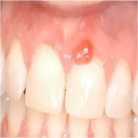 ziarniniak ciężarnych