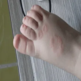 ziarniniak obrączkowaty u dzieci na kończynach