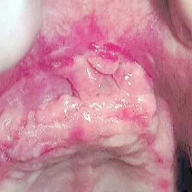 ziarniniak olbrzymiokomórkowy