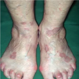 ziarniniak pierścieniowy  