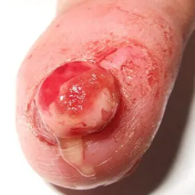 ziarniniak ropotwórczy choroba