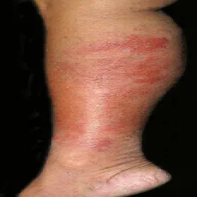 Zmiany na skórze choroba róża