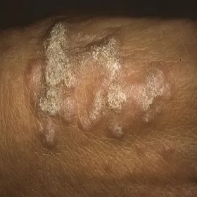  zmiany na skórze w postaci grudek liszaj płaski