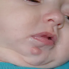 zmiany skórne na brodzie u dziecka