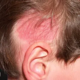 zmiany skórne na głowie u dziecka