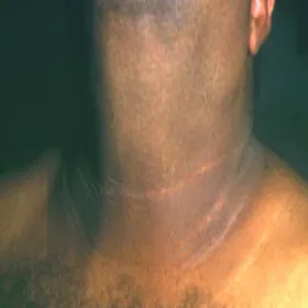 zmiany skórne na szyi i karku