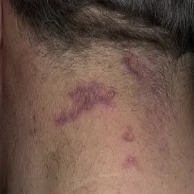 zmiany skórne na szyi liszaj płaski