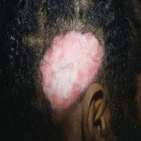 zmiany skórne w toczniu na głowie