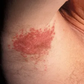 zmiany skóry pod pachami odparzenia