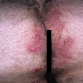 zmiany w okolicy odbytu zdjęcia