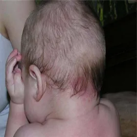 znamię uszczypnięcie bociana